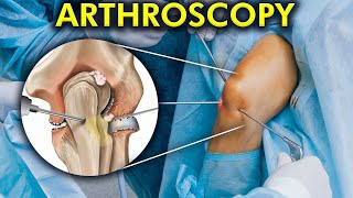 The World of Arthroscopic Surgery How Arthroscopy is performed Include 3d animation [upl. by Tryck803]