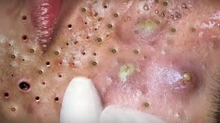 Big Cystic Acne Blackheads Extraction Blackheads amp Milia Whiteheads Removal Pimple Popping  5343 [upl. by Dove]