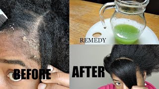 HOME MADE REMEDY FOR DANDRUFF CURE  THIS WILL GET RID OF YOUR DANDRUFF [upl. by Hulen]