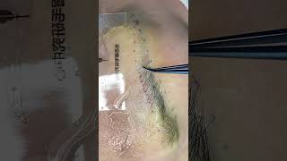 eyebrow transplantation eyebrow eyelashextensions eyebrown hairtransplantation eyebrows [upl. by Ennairej]