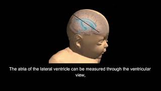 Normal Fetal Head Anatomy and Common Malformations [upl. by Cerf]