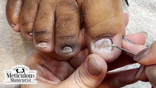 Toenail Fungus at Home Remedy [upl. by Petes108]