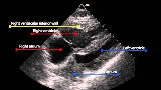 9 Subcostal view in pulmonary hypertension [upl. by Miki680]