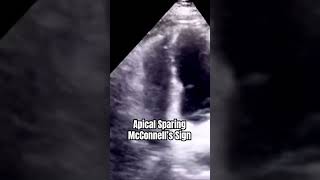 McConnell’s Sign echocardiography [upl. by Zelikow]