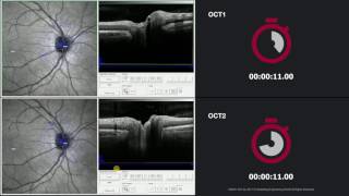 SPECTRALIS OCT1 vs OCT2 Glaucoma – ONH Circle Scan [upl. by Hoopen]