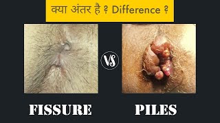 Piles vs Fissure  Difference [upl. by Notyep]