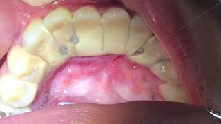 Houston Cosmetic DentistWorst Tartar I have seen Watch how we remove it [upl. by Rahr]