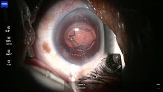 OS 2024 09 30 074245 phaco Eyhance reverse pupillary block [upl. by Enywad286]