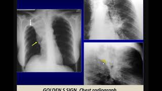 Imaging of bronchogenic carcinoma [upl. by Nrubua]