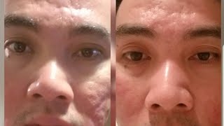 Deep acne scar before and after using Dermapen [upl. by Werra]