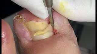 Double ingrown nails treatment [upl. by Weldon]