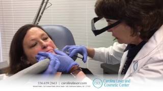 Dr Anne White WinstonSalem  Restylane Refyne and Defyne Live Demo [upl. by Leahcimed]