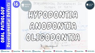 Hypodontia  Anodontia  Oligodontia  Developmental disturbances of teeth  Dr Paridhi Agrawal [upl. by Nedry707]