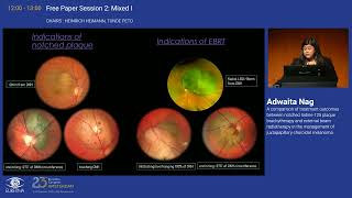 5 A comparison of treatment outcomes between notched Iodine125 plaque brachytherapy and external b [upl. by Turro]