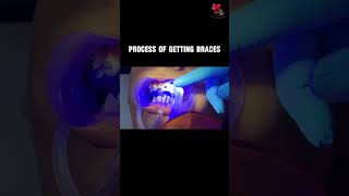 Lets demystify the process of getting braces 😁 [upl. by Rainger967]