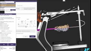 How to Align an Articulator in EXOCAD [upl. by Bainbrudge970]