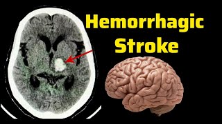 Hemorrhagic Stroke Brain bleed  CT Brain Radiology  Hemorrhage [upl. by Acker]