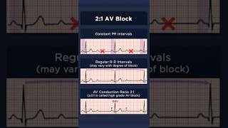 21 Atrioventricular Block ECG [upl. by Gaiser]