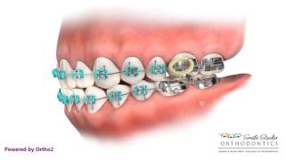 Elastics  Class III  Orthodontic Treatment [upl. by Lohrman]