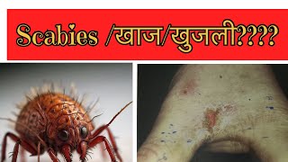 स्केबीज खाज  खुजली scabies scabies scabiestreatment [upl. by Ariaj644]