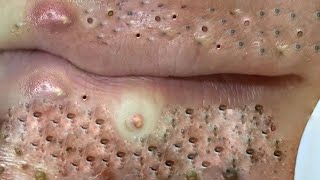 Big Cystic Acne Blackheads Extraction Blackheads amp Milia Whiteheads Removal Pimple Popping  6549 [upl. by Warrin785]