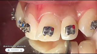 TUTORIAL ¡INSTALACIÓN de BRACKETS metálicos en dientes frontales INCISIVOS [upl. by Anairad750]