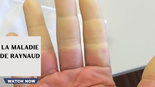 la maladie de raynaud trouble de la circulation sanguine aux extrémités [upl. by Jeanne719]