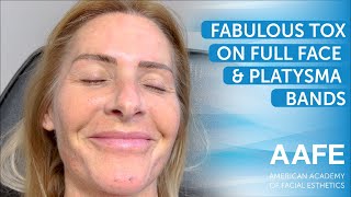 Fabulous Tox on Full Face amp Platysma Bands [upl. by Rastus840]