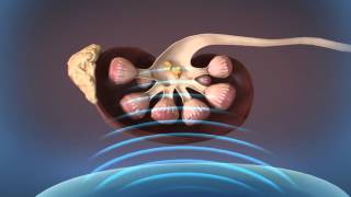 Shockwave Lithotripsy SWL [upl. by Llerret]