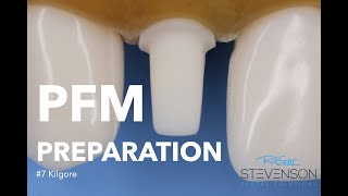 PFM Preparation on Tooth 7 Kilgore  Stevenson Dental Solutions [upl. by Yedrahs898]