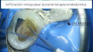 Anestesia intrapulpar durante terapia endodontica [upl. by Brittne218]