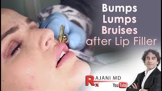 Bumps Lumps Swelling and Bruising after lip FillersDr Rajani [upl. by Olrak]