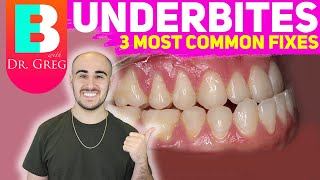 BRACES EXPLAINED Underbite  Crossbite Correction [upl. by Giordano420]