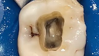 Maxillary Molar Access Cavity Preparation Part 5 [upl. by Pangaro]