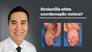 Sindactilia existe tratamento sem cirurgia [upl. by Manya464]