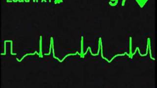 Ventricular Bigeminy  ECG Simulator  Arrhythmia Simulator [upl. by Yci336]