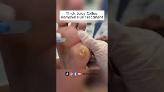 Ultimate Callus Removal Full Treatment For Smooth Feet  FootClinicLondoncouk [upl. by Emya190]