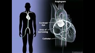 Coronary Arteriography  Coronary Angiography  Definition Procedure Uses Benefits [upl. by Suelo]