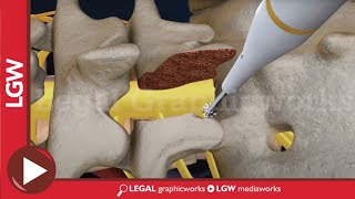 L5S1 Lumbar Discectomy and Fusion Surgery 3D animation [upl. by Latreese]