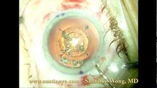 Lensx laser cataract surgery technique 122712 [upl. by Zinah]