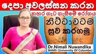 Treatments for Varicose veins  නහර ගැටගැසීම නිට්ටාවටම සුවකරගමු  Dr Nimali Nuwandika [upl. by Erroll]