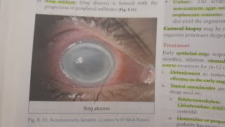 Acanthamoeba Keratitis  EYE [upl. by Merissa]