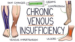 Understanding Chronic Venous Insufficiency [upl. by Aihpos]