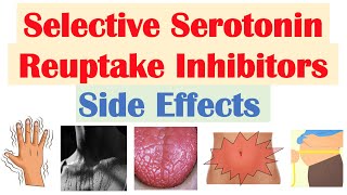 SSRI Antidepressant Side Effects amp Why They Occur  Fluoxetine Paroxetine Sertraline Citalopram [upl. by Annaer]