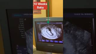 10 Week Baby 😱😱  USG  Bsc Nursing Students life youtubeshorts trendingshorts ytshorts shorts [upl. by Airtap]