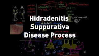 Hidradenitis Suppurativa HS or Acne Inversa Disease Process Explained [upl. by Ynatil798]