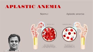 Aplastic Anemia [upl. by Nosreffej195]