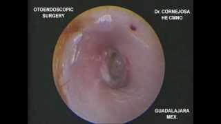 EXPLORACIÓN ENDOSCÓPICA DE MEMBRANA TIMPÁNICA PERFORADA Dr Cornejosa [upl. by Anifled]