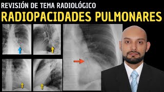 Revisión de Tema 88 Radiopacidades pulmonares [upl. by Chiles428]