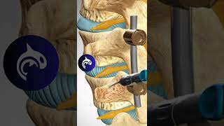 See how a Lumbar Fusion of the Spine works in 3D animation backpain stem spine [upl. by Earle]